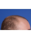 Before Hair Transplant&nbsp;Front